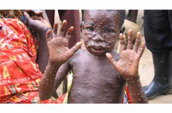 Mpox පැතිරෙන්නේ කෙසේද සහ වඩාත්ම අවදානමට ලක්ව ඇත්තේ කවුද?